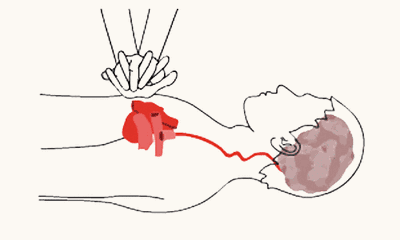 等待救援 耐心等待急救人员到达,尽快送到医院.