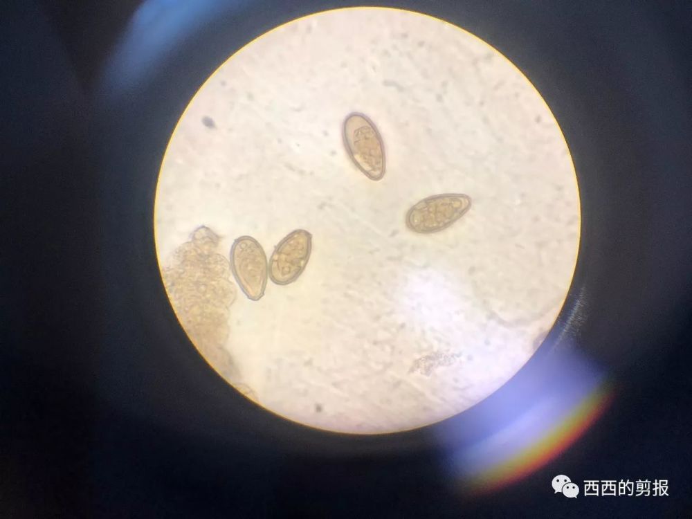 华支睾吸虫虫卵:像西瓜子/小芝麻,有卵盖和肩峰,小疣不明显,卵内是一