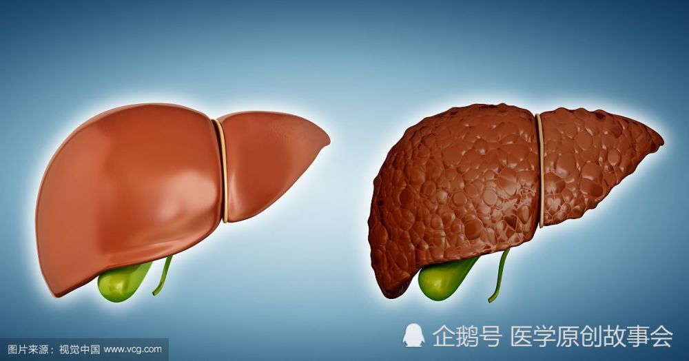肝癌,肝硬化,肝脏,脂肪肝,病毒性肝炎