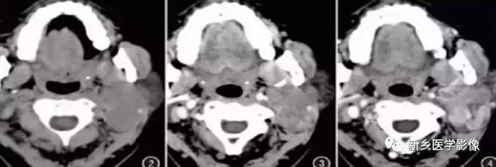 79岁男性腮腺和盆腔同时长肿瘤,怎么回事?