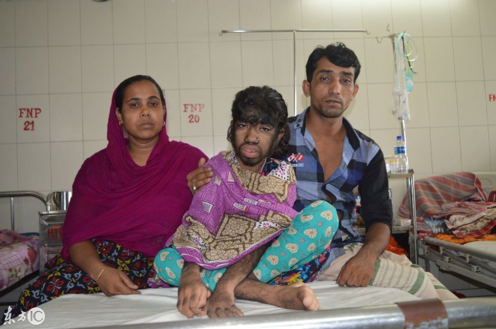 12岁女孩胸部提早发育,全身毛发疯狂生长像野人,看着太可怕!