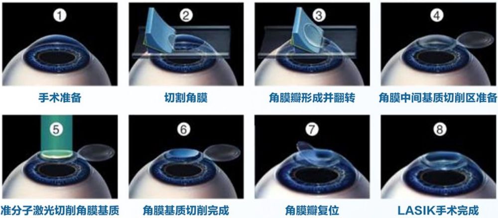lasik近视手术基因检测