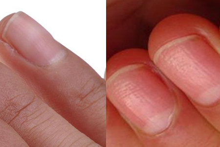 手指甲凹凸不平有横沟,一定要知道的健康信号