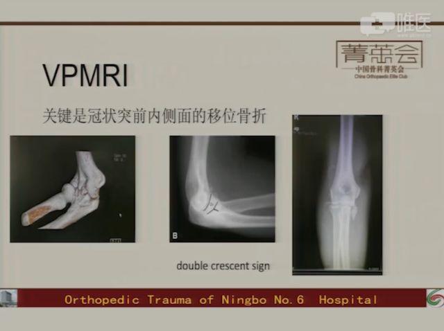 尺骨冠状突骨折治疗经验分享