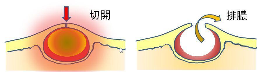 皮脂腺囊肿俗称"粉瘤",由于皮脂腺排泄管阻塞形成的潴留性囊肿