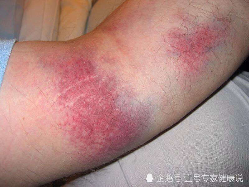 睡醒一觉,突然发现身体出现淤青,你要小心了!