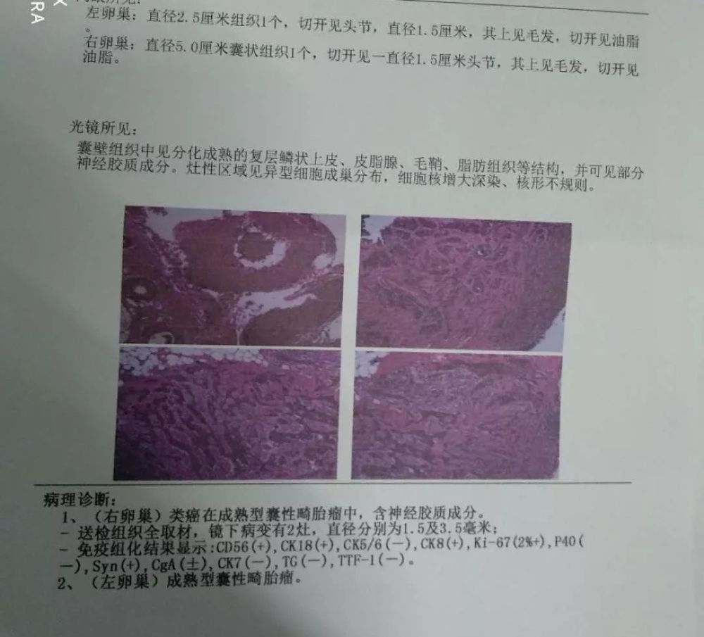 病例三: 19岁患者,未婚,因白带多不适看病,妇检时发现宫颈充血12点处