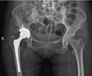 跛行20余年,行全髋关节置换术后丢掉拐杖,回家