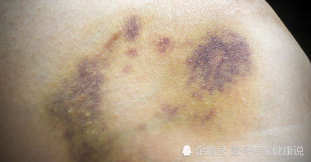 睡醒一觉发现自己浑身淤青,医生告诉她患上了