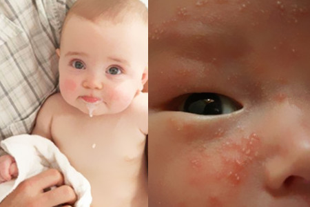 婴儿蛋白质过敏症状有哪些 如何才能彻底解决