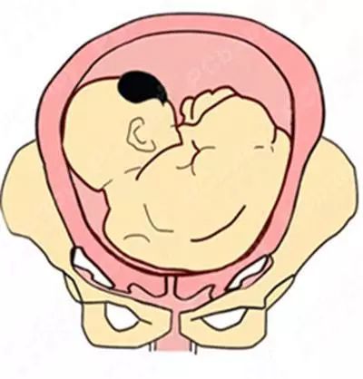 即将临产,胎儿却顽皮的横在妈妈肚子里,孕妇腹