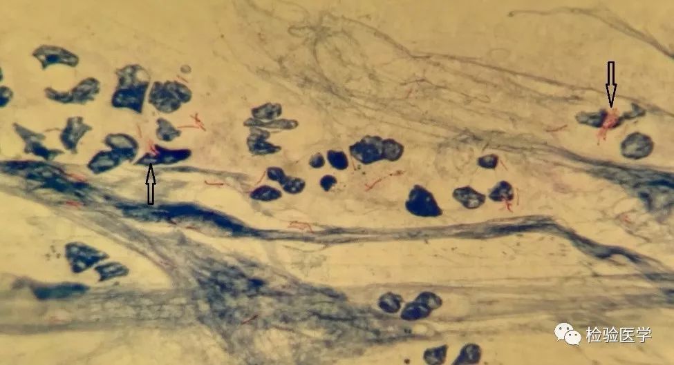 被染成紫色的抗酸杆菌