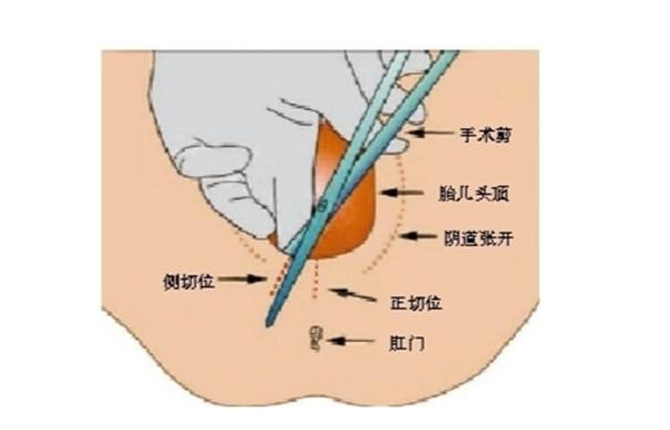 女人顺产的时候常说的侧切指的是什么,准妈妈