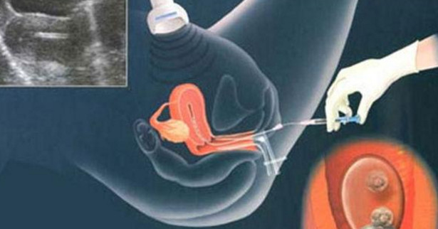 女性做试管婴儿取卵有什么感觉,不同的人感觉