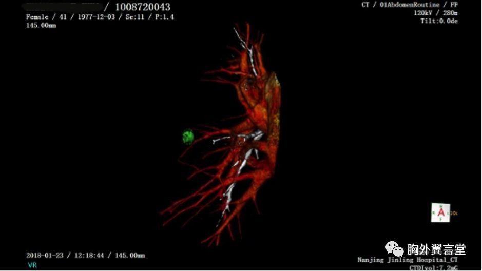 天网恢恢,致肺结节无处安放的青春