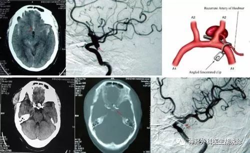颅内动脉瘤到底应该怎么治疗
