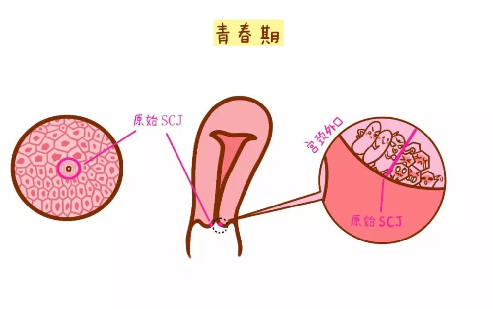宫颈囊肿——宫颈上的"青春痘"