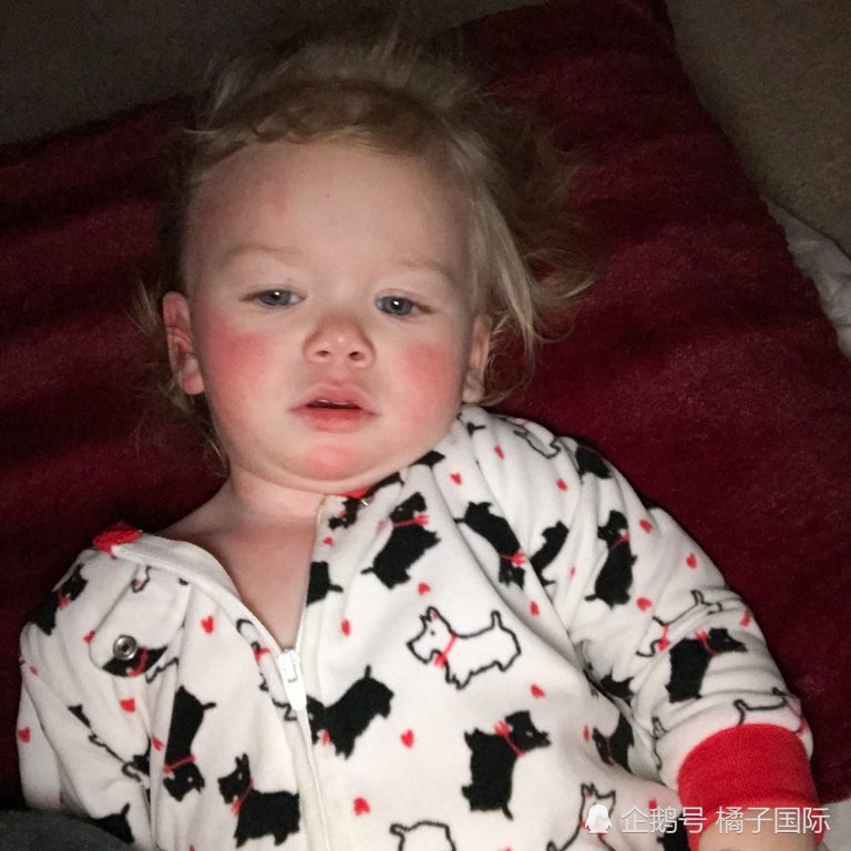 18个月大宝宝对水过敏 出汗和流泪都让她非常