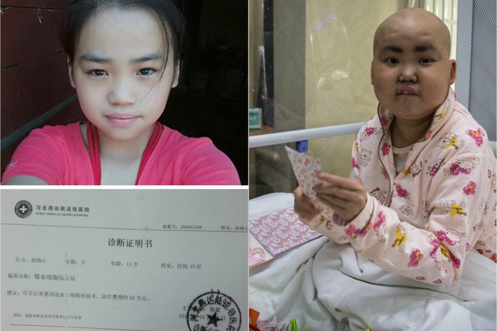 12岁漂亮女孩变可怕激素脸 做手工换钱维持