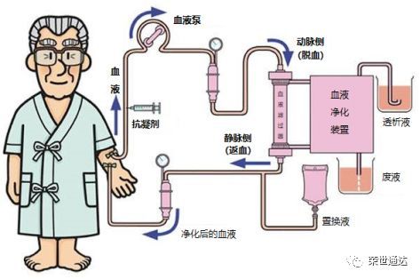 血液透析 血液滤过与特殊血液净化的区别 看点快报