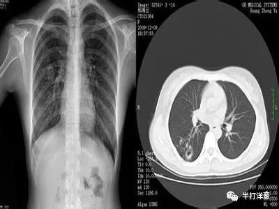 非肺癌高危人群,体检拍胸片是不是就不用做?