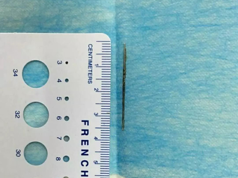 男子误食大头针提心吊胆,卡喉咙一周方才送医