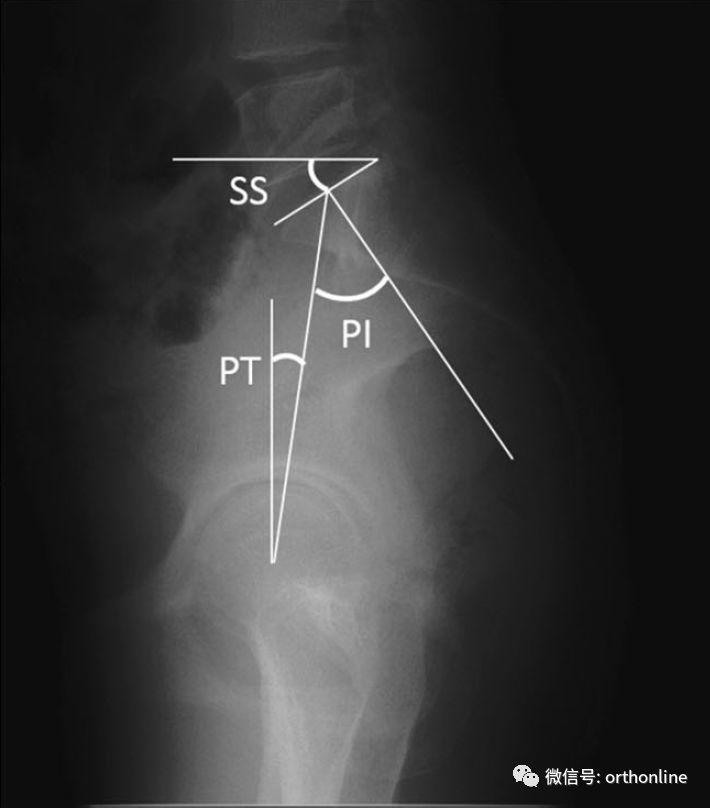 确定脊柱手术矢状面矫形度数的几种实用方法