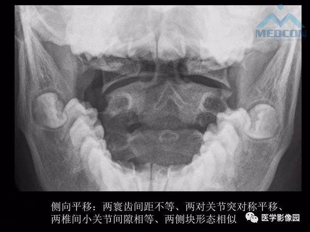 寰枢关节脱位的影像学诊断