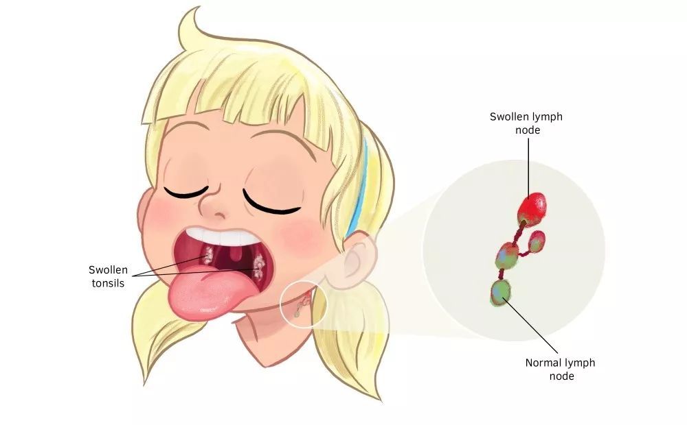 孩子喉咙疼 小心得了链球菌性咽喉炎 看点快报