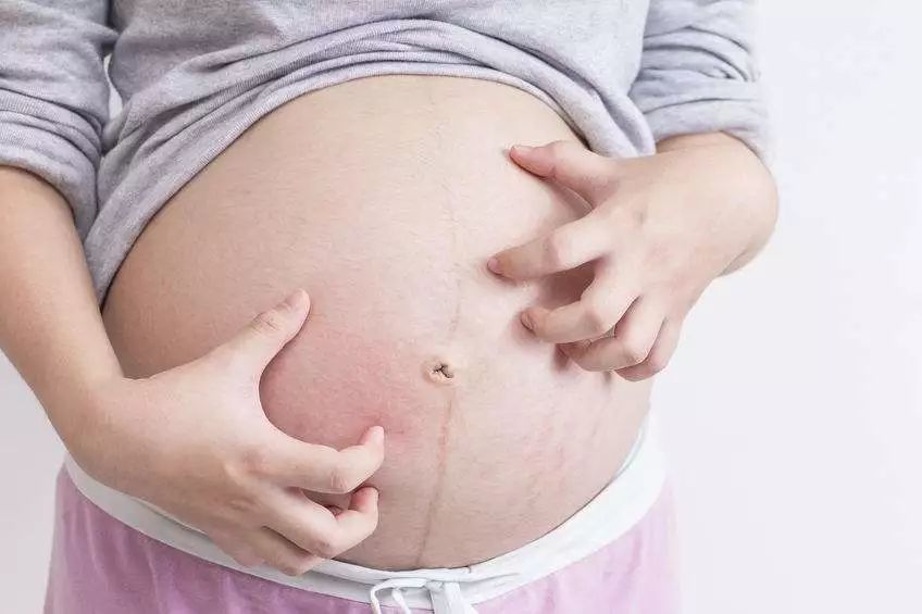 准妈妈身上的这个地方 痒 不能小瞧也不能乱挠 看点快报