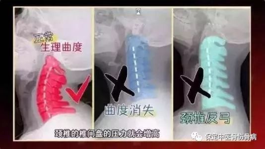 颈椎反弓是什么?如何恢复?-天天快报