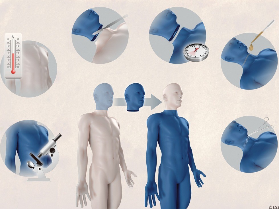 斥资千万美元，全球首例换脑手术将展开(图)