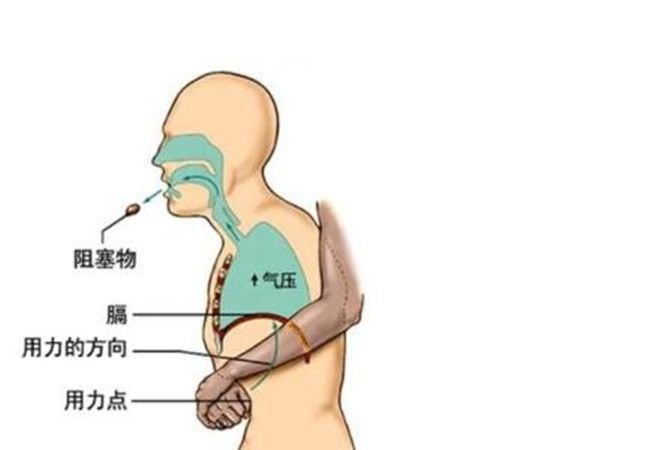 2,催吐法:用手指伸进口腔,刺激舌根催吐,适用于较靠近喉部的气管异物.