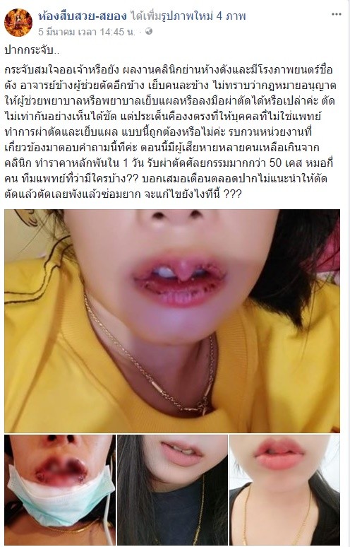 泰国性感女神竟是三瓣嘴 都怪整容遇到假医生
