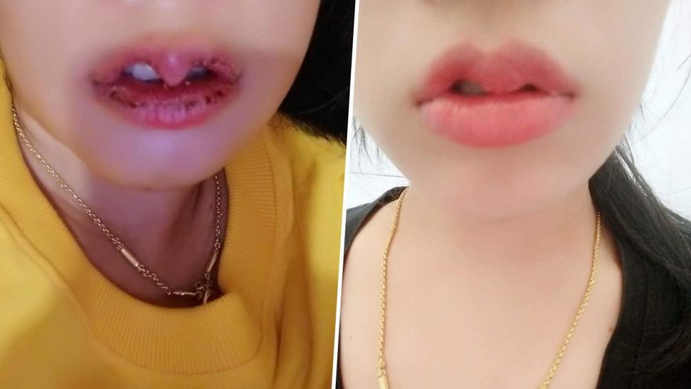 女孩说:她发帖是想提醒大家,整容整形一定要慎重,人不是机器,一旦坏