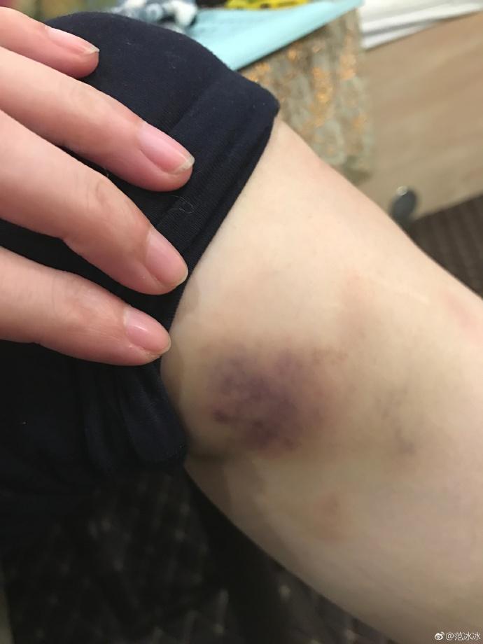 看着照片腿上的淤青网友表示心疼了:晨哥会担心的,加油哦