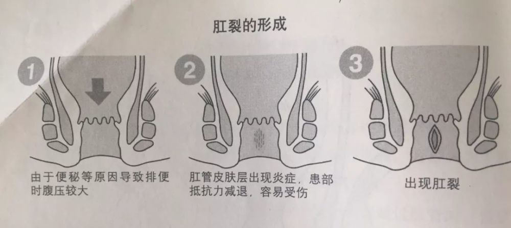 1 肛裂是什么原因引起的? 2 肛裂和痔疮有什么关系?