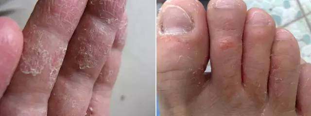 老中医偏方:治脚气偏方 治疗脚气的小偏方