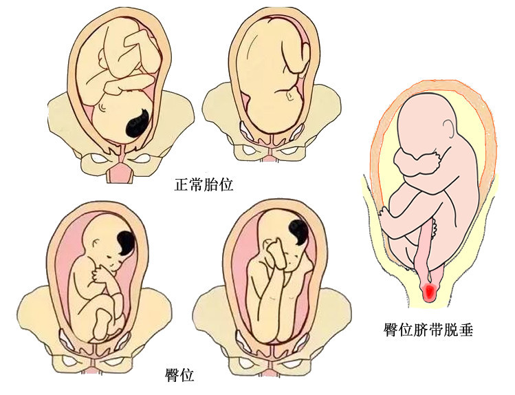 词汇1臀位