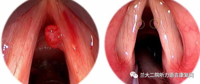 急性喉炎:喉部粘膜急性红肿,声带由白色变成红色,并肿胀.