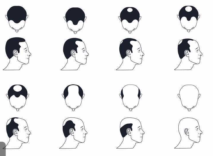 常见的脱发类型有这4种,快来对照下!