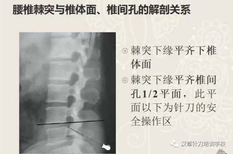 腰椎棘突在针刀定位治疗中的重要性