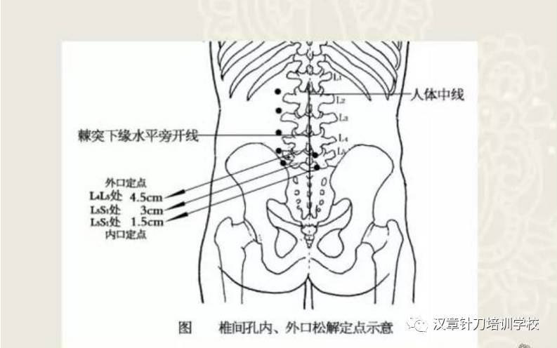 腰椎棘突在针刀定位治疗中的重要性