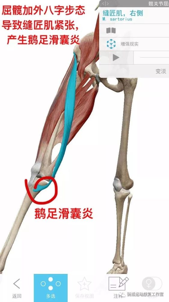 鹅足滑囊炎就是因为缝匠肌的过度收缩,导致滑囊牵拉出现炎性反应.