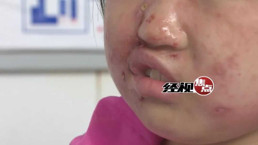 长沙9岁女孩患"怪病"脸起红疹 鼻子,嘴巴肿胀变形