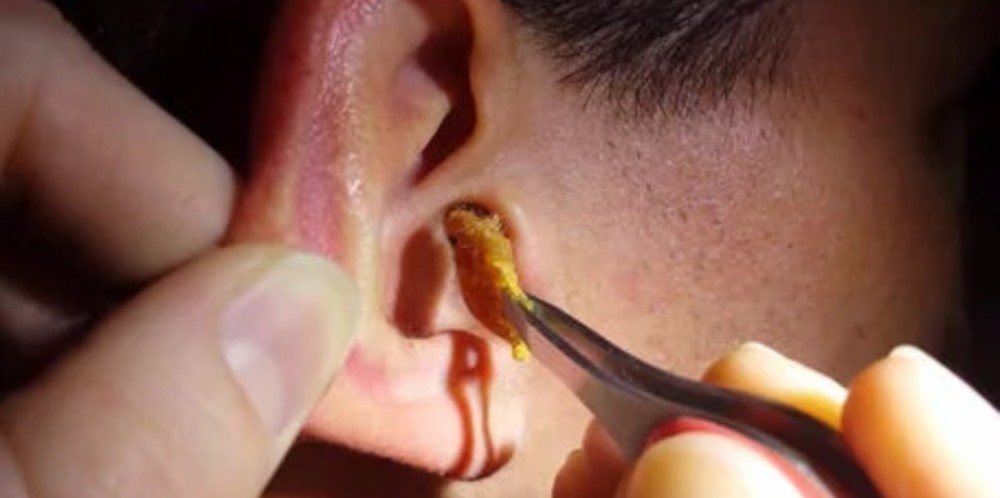 耳屎真的需要经常清理吗?看耳鼻喉科医生怎么说?