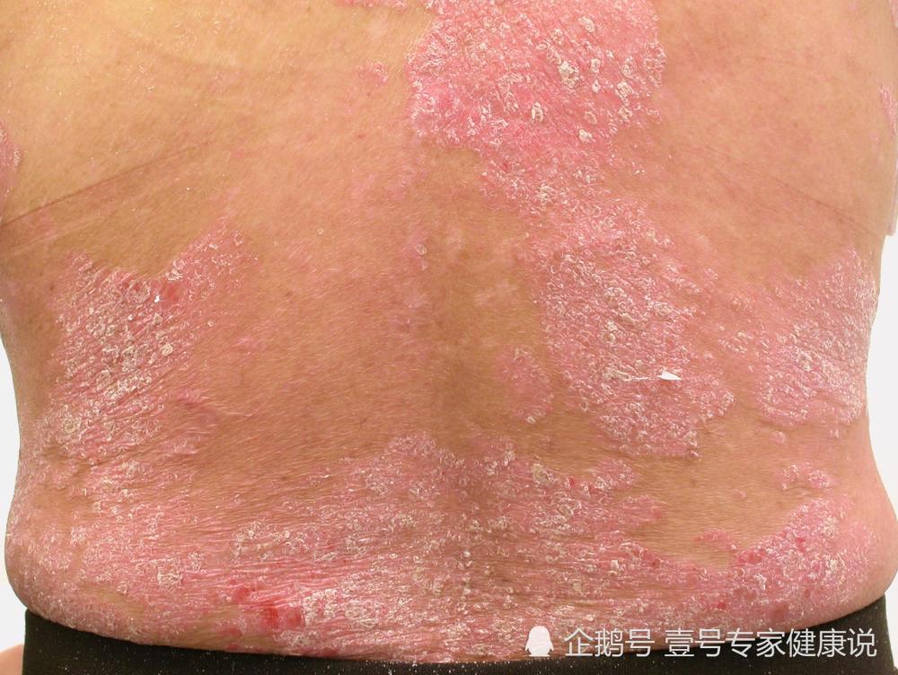 皮肤科医生 别小看牛皮癣 几年后会 升级 成这个病 看点快报