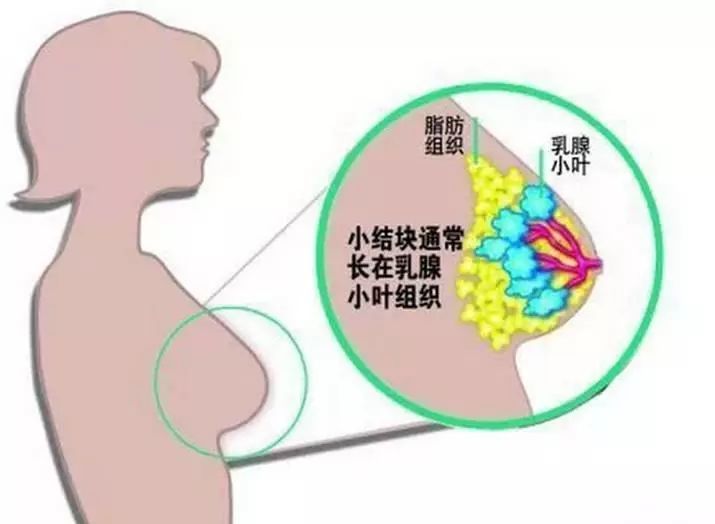 十个女生体检有九个查出它!乳腺增生你真的了解多少?