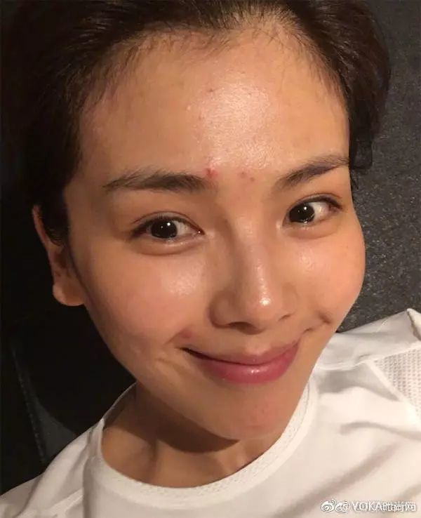 郑爽直播教大家挤痘痘,到底怎么挤才不会留疤