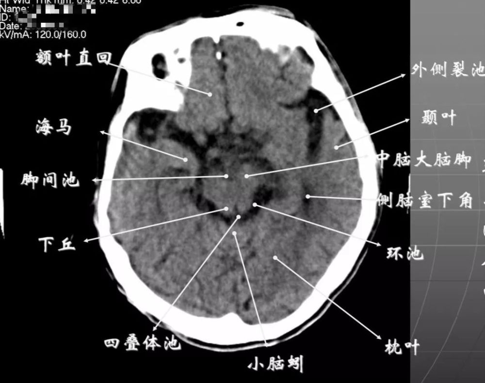 鞍上池:在垂体窝上方,位于两侧颅中窝之间,前界为颞叶直回,侧方位